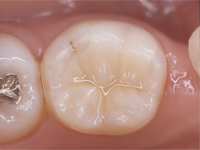 歯科技工物のイメージ